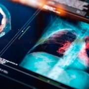 Lung scan