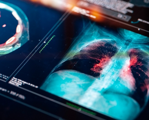 Lung scan