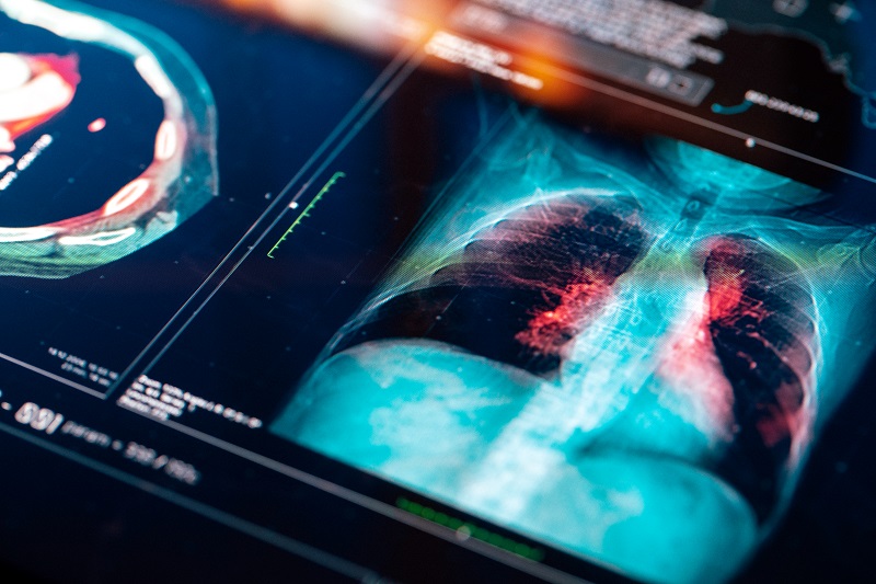 Lung scan